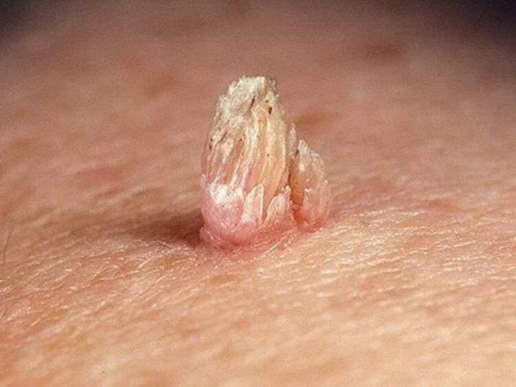 Papiloma genital no corpo