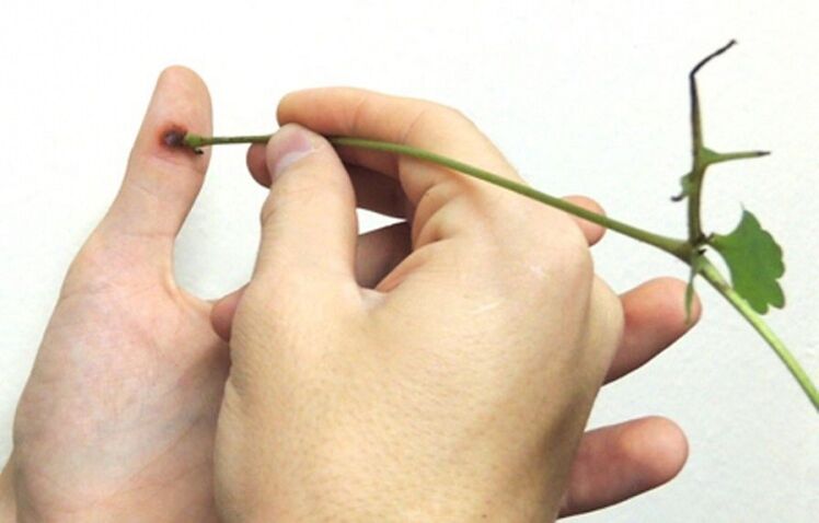 Remoção de uma verruga no dedo com suco de ervas de celidônia